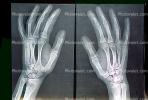 hand, fingers, knuckles, X-Ray, HASV01P08_14