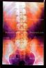 pelvis, back, vertebrae, spine, X-Ray, HASV01P09_13B