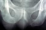 Hip Bone, Pelvis, X-Ray, HASV01P10_02