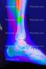 Ankle, leg, foot, X-Ray, HASV01P10_08B.2014