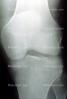 knee, X-Ray, HASV01P10_13