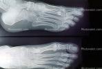 foot, toes, X-Ray, HASV01P11_09