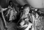 Leprosy, Refugee Camp, near the Ethiopia Somalia border, African Diaspora, Somalia, POV35V07P43_01