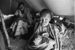 Leprosy, Refugee Camp, near the Ethiopia Somalia border, African Diaspora, Somalia, POV35V07P43_02