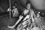 Leprosy, Refugee Camp, near the Ethiopia Somalia border, African Diaspora, Somalia, POV35V07P43_06