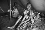 Leprosy, Refugee Camp, near the Ethiopia Somalia border, African Diaspora, Somalia, POV35V07P43_07