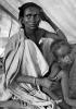 Tuberculosis, Refugee Camp, near the Ethiopia Somalia border, African Diaspora, Somalia, POV35V07P44_20B
